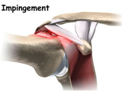 Sindrome Subacromial