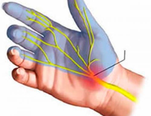 Sindrome del Tunel Carpiano