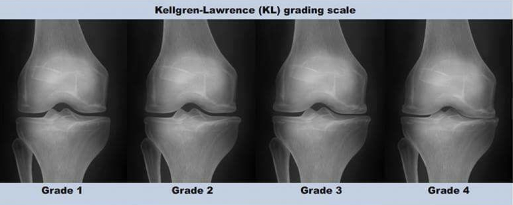 Artrosis rodilla. Clasificación radiológica de Kellgren y Laweance, grados de artrosis