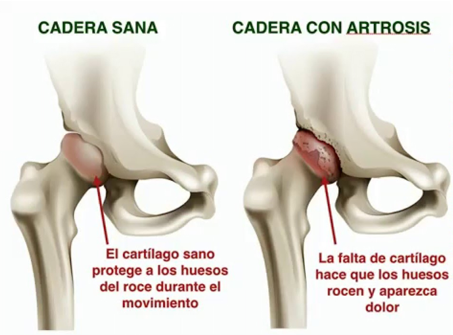 artrosis de cadera o coxartrosis. Infiltración con ácido hialurónico