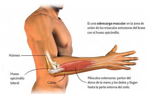 epicondilitis o codo de tenista. Diagnóstico y tratamiento en Clínica Altamira.