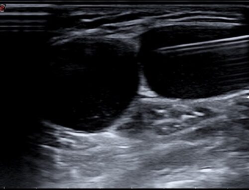 Extracción Ecoguiada de Quiste Sinovial